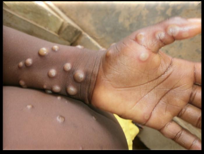 Pernambuco confirma dois novos casos de varíola dos macacos; 132 seguem em investigação