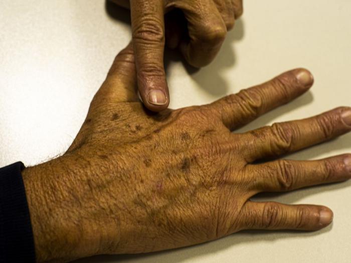 Dezembro Laranja: Câncer de pele é o mais comum no Brasil; saiba como evitar